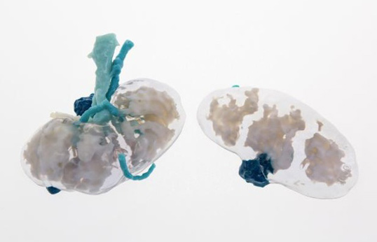 Modely orgánů s rakovinou vyrobené 3D tiskem zachraňují životy