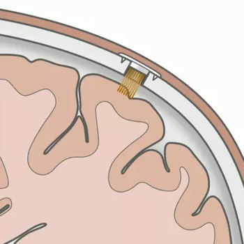 Elon Musk představuje Neuralink, čip pro čtení myšlenek